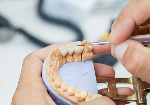 A dental lab technician creating a dental bridge for a patient who has lost multiple teeth