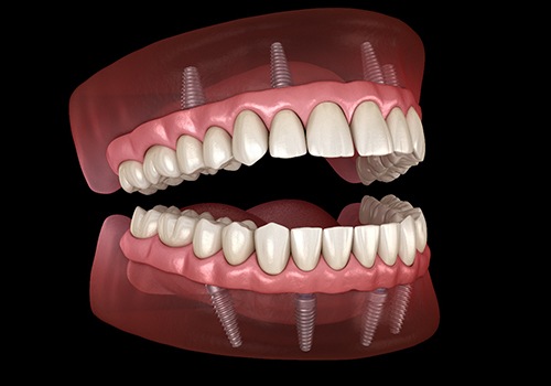 Illustration of all-on-4 dental implants