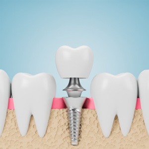 A 3D illustration of a dental implant alongside healthy teeth