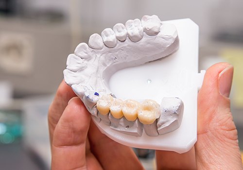 Closeup of model teeth with fixed bridge restoration