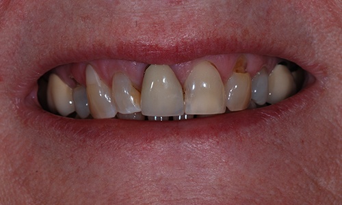 Discolored and decayed teeth