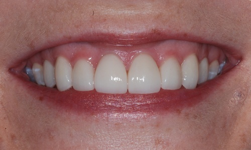 Flawless smile with custom porcelain veneers