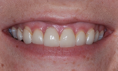 Older dental bonding treatment that has discolored