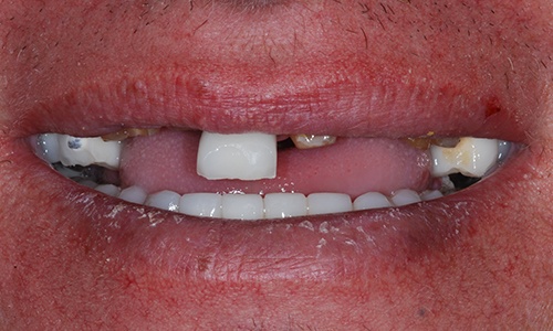 Smile with several missing teeth after bicycle accident