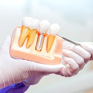 Dentist using model to explain dental implant procedure