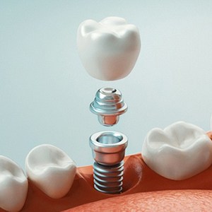 Illustration of implant, abutment, and restoration being placed in mouth