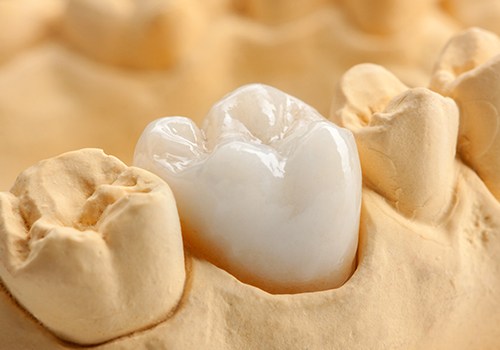 Up-close view of a dental implant between two teeth