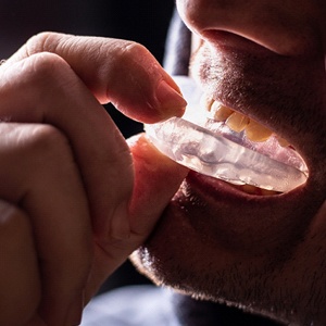 Man removing custom mouthguard from his mouth