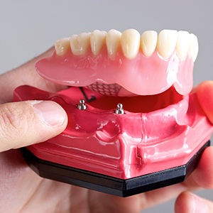 Implant dentist holding model implant denture in Kerrville 