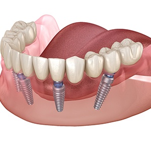 Digital illustration of all-on-4 implant dentures in Kerrville