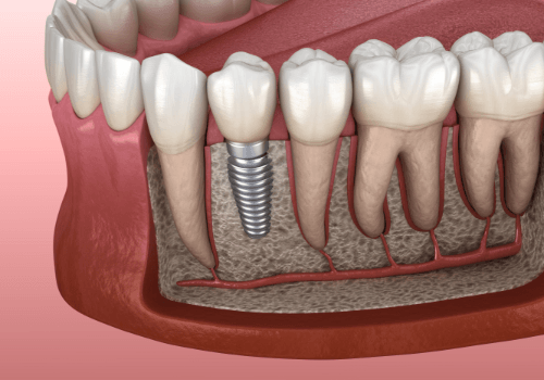 Animated implant supported dental crown