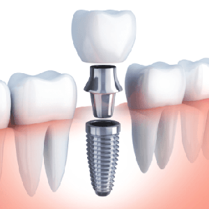 Animated implant supported dental crown placement