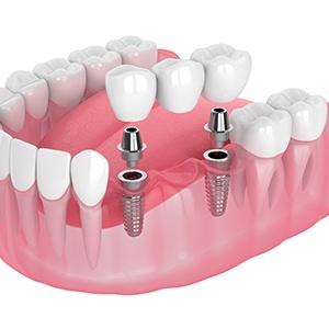 Digital diagram of implant bridge replacing multiple missing teeth in Kerrville 