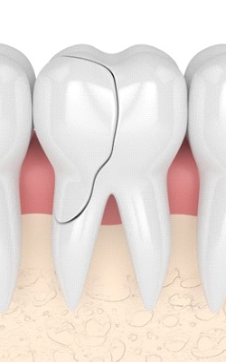 Digital image of a cracked tooth