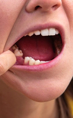 Woman pulling her lip back to reveal missing tooth