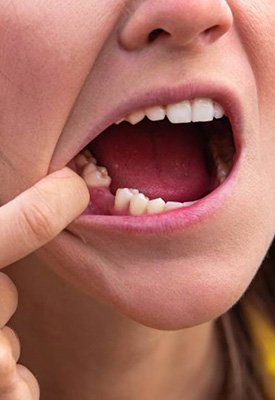 Woman pulling back her lip to reveal missing tooth