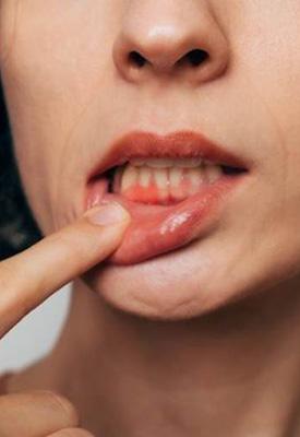 Woman pulling back her lip to reveal red gums