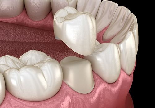 A digital image of a dental crown being placed over a tooth located on the bottom arch