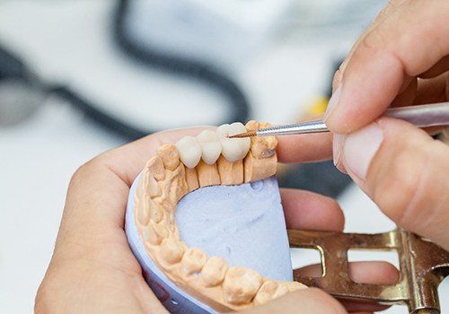 A dental lab technician creating a dental bridge for a patient who has lost multiple teeth
