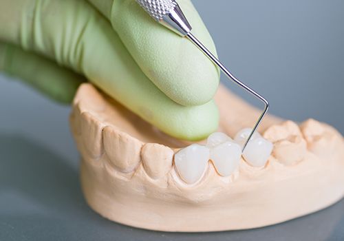 Model smile with fixed bridge restoration