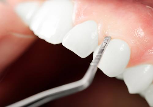 close up dental instrument against gum tissue 