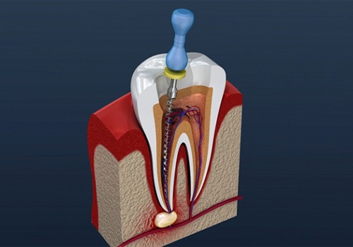 diagram of the root canal procedure 