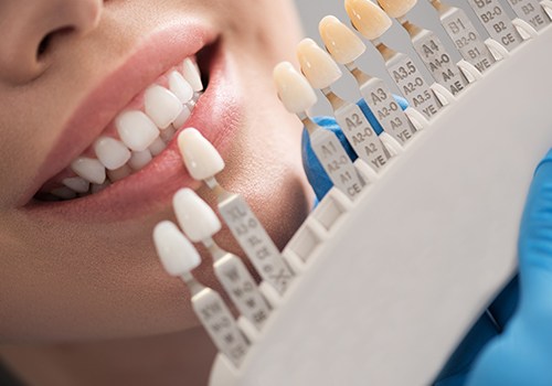 Smile compared with porcelain veneer shade chart