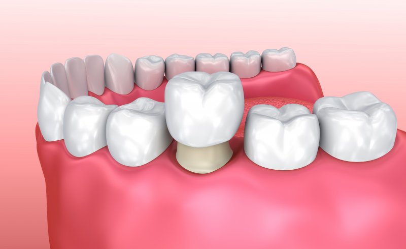 Placing a dental crown on a tooth