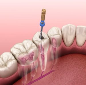 root canal illustration
