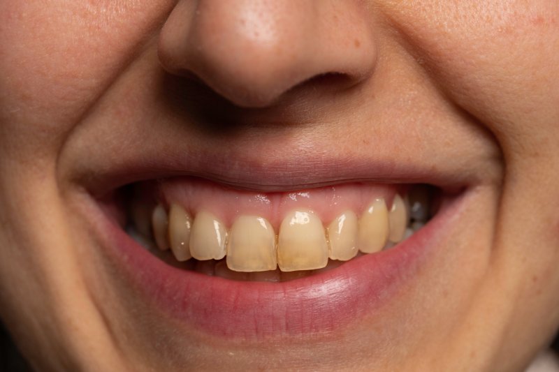 Stained teeth, one of the most common cosmetic dental flaws