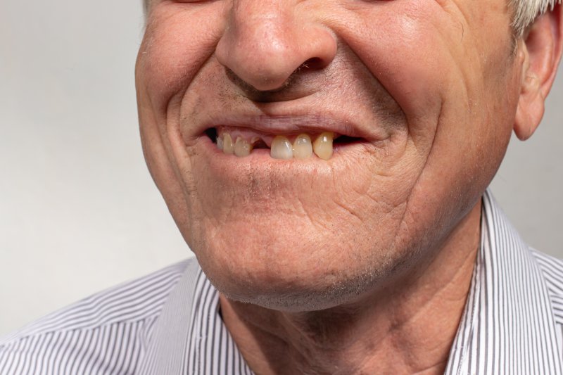 man suffering from tooth loss