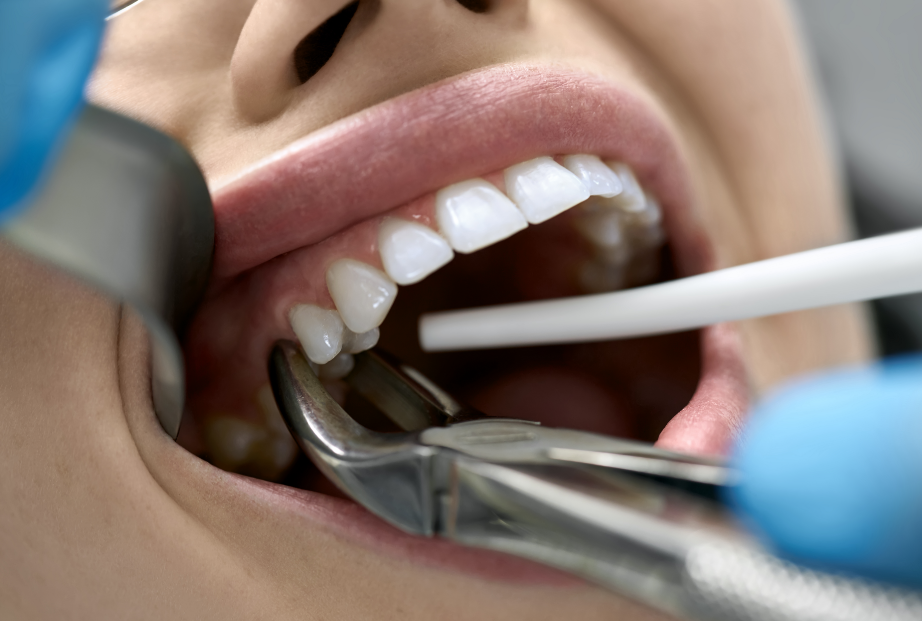 Dental extraction