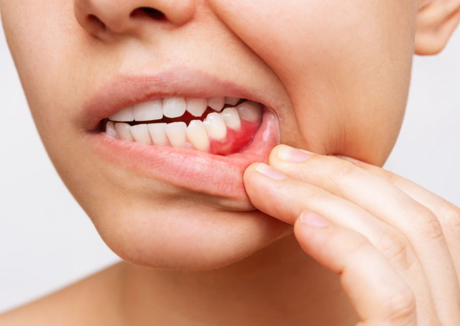 Woman pulling lip down to show inflamed gums
